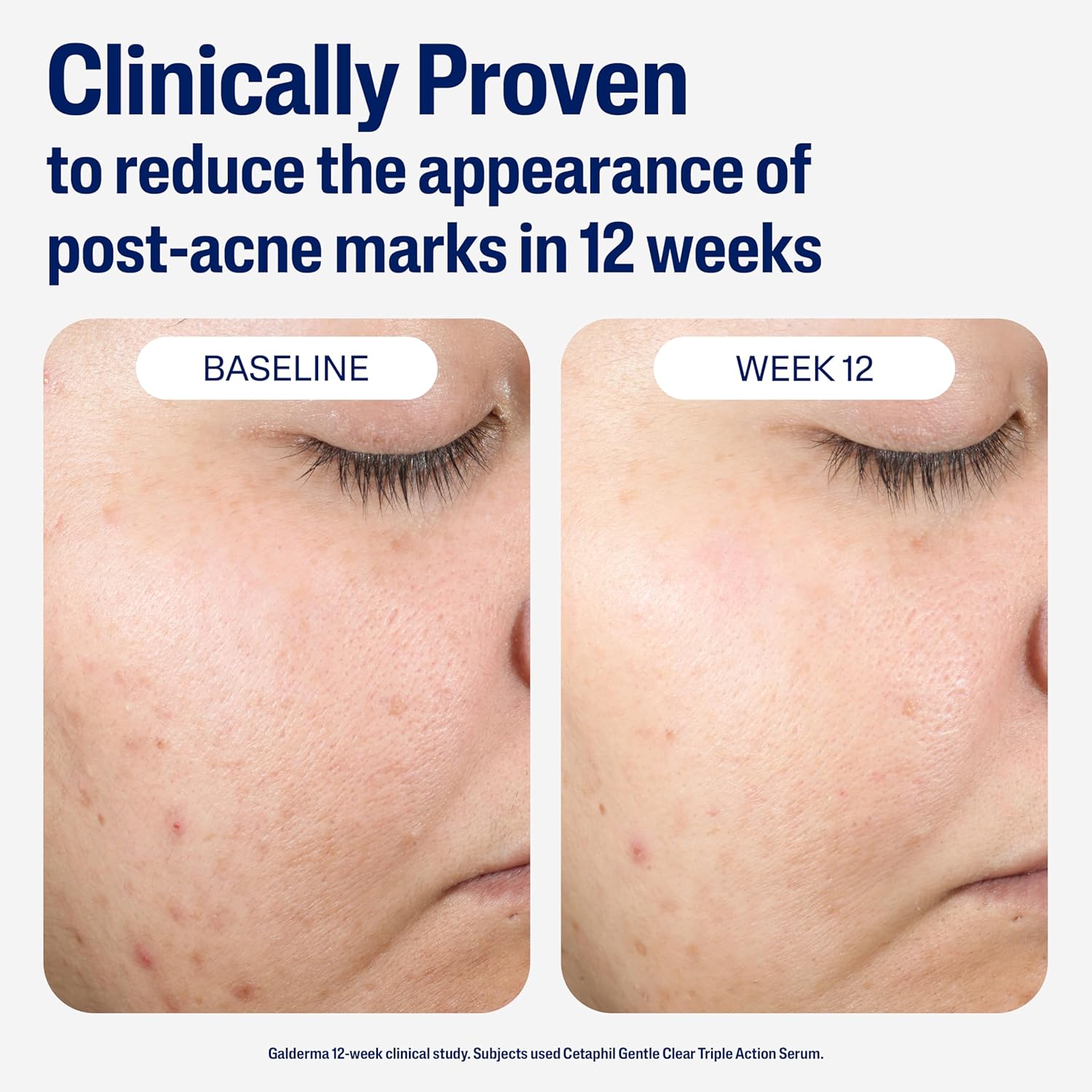 Cetaphil Acne Gentle Clear Repairing Post-Acne Serum 30ml - Image 3