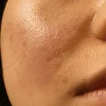 Blackheads & Whiteheads care